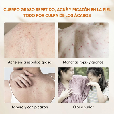MITE Y ACNE
